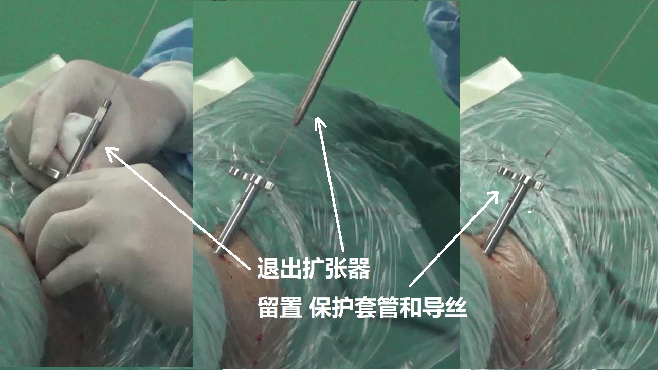 8-退出擴張器-留置保護套管和導(dǎo)絲.jpg