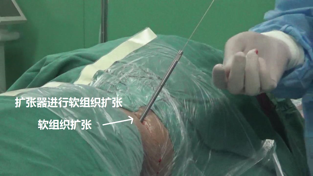5-擴張器軟組織擴張.jpg