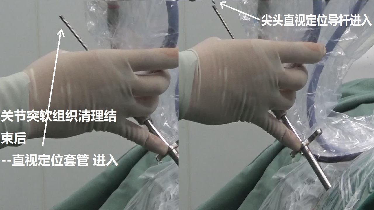 11-直視定位導(dǎo)桿進入到關(guān)節(jié)突.jpg