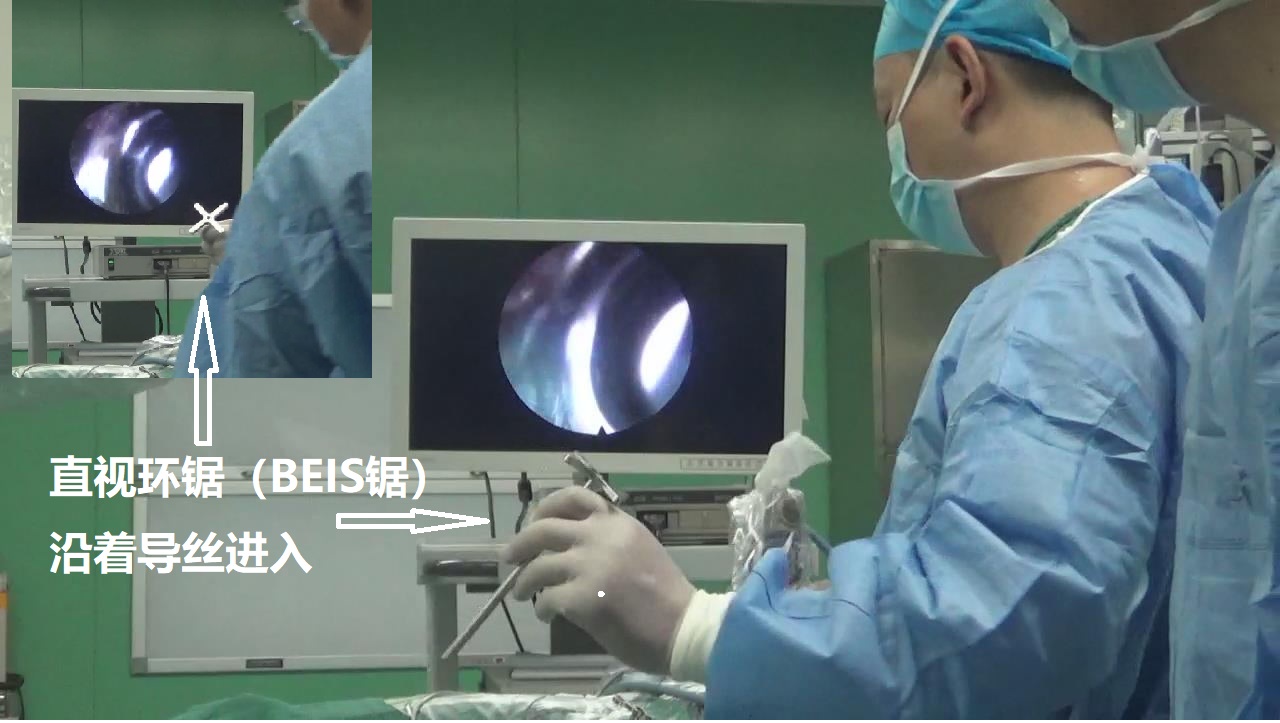 15-直視環(huán)鋸（BEIS鋸）沿著導(dǎo)絲進入.jpg